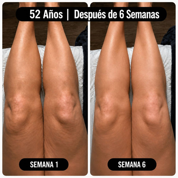 Resultado: 52 años, después de 6 semanas — piernas