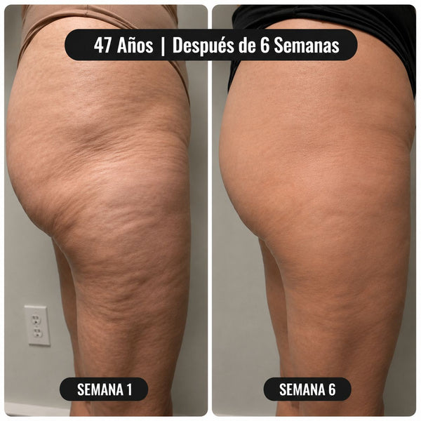 Resultado: 47 años, después de 6 semanas — glúteos